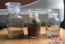 男子20年體外碎石200余次 結石仍長滿腎臟