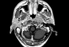“無創DNA產檢”之父新成果：通過血液篩查早期鼻咽癌