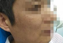 廣州大叔鐵片藏臉30年未發現，取出后自己嚇一跳