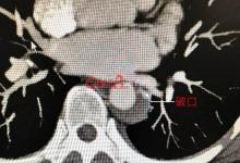 女子練瑜伽致心臟主動脈破裂 醫生稱第一次見