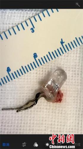 男孩誤吞LED發(fā)光二極管 深入支氣管險些扎破肺