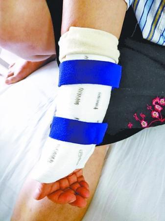 武漢首個玉米淀粉3D打印支具“上手”