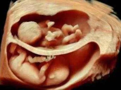 懷了雙胞胎又驚喜又擔憂，唐山寶島婦兒醫院為您保駕護航