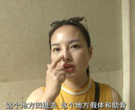 杭州美萊美容醫(yī)院把我鼻子做壞了 高價隆鼻后凹凸不平