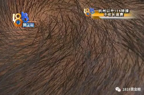 小伙在杭州新生植發花幾萬元植發效果不好 頭皮發癢還掉發