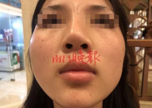 南昌禾麗整形醫院把我鼻子整歪了 記者介入協調才同意免費修復-易網健康<a href=http://m.henggaotouzi.com/jkys/ target=_blank class=infotextkey>養生</a>網 南昌禾麗整形醫院把我鼻子整歪了 記者介入協調才同意免費修復