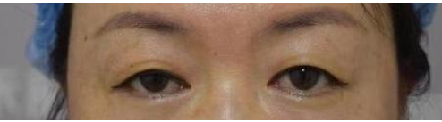 南昌禾麗整形失敗 女子花18000整形后跟術(shù)前照對(duì)比尷尬了