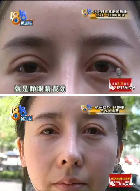 花八萬多在杭州顏控國際醫療美容后比以前還丑 她說著說著流淚了