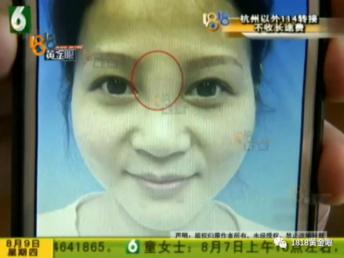 想要“柔美”結(jié)果寧波益寶醫(yī)療美容把她整像豬頭？