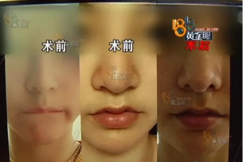 杭州畫蝶醫療美容醫院做整形 鼻子沒做好做成了豬頭鼻