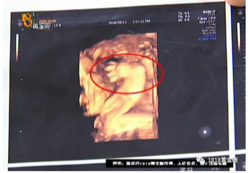 杭州余杭婦產醫院沒查出胎兒雙手畸形要不要擔責？B超能查胎兒畸形嗎？