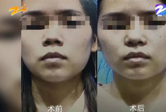 杭州甄美整形醫院把人鼻子整歪了？醫院：自己長歪了