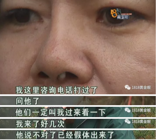 六年前在寧波珈禾整形專科醫(yī)院做隆鼻 現(xiàn)在鼻子不舒服露出白色假體