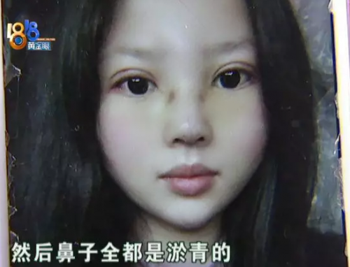 女子在嘉興長紅門診部整形后整個(gè)人都崩潰了 姑娘采訪從頭哭到尾