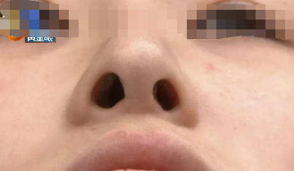 杭州千晴整形醫(yī)院隆鼻后耳后根長了個包 鼻孔也一大一小-易網(wǎng)<a href=http://m.henggaotouzi.com/ target=_blank class=infotextkey>健康養(yǎng)生</a>網(wǎng) 杭州千晴整形醫(yī)院隆鼻后耳后根長了個包 鼻孔也一大一小