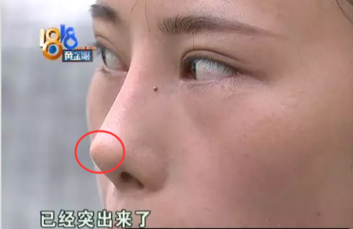 杭州恒麗醫(yī)療整形手術7個月后越看越不喜歡 鼻尖凸出來了