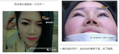 動了三次刀 患者：湖州曙光醫療美容醫院把我鼻子做的跟豬一樣