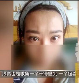 貸款6萬多在西安華醫天美整形醫院整容后變丑了 女子流下后悔的眼淚