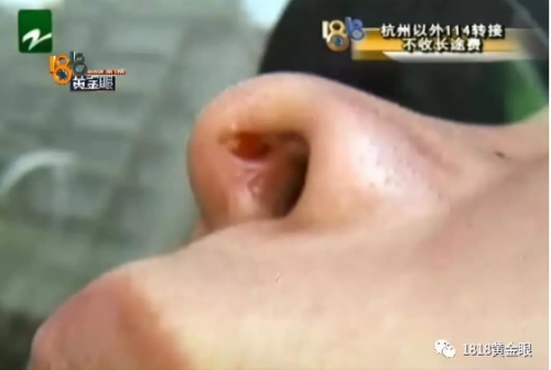 女子在寧波尚美整形醫院整形失敗 手術效果差傷口還化膿-易網<a href=http://m.henggaotouzi.com/ target=_blank class=infotextkey>健康養生</a>網 女子在寧波尚美整形醫院整形失敗 手術效果差傷口還化膿