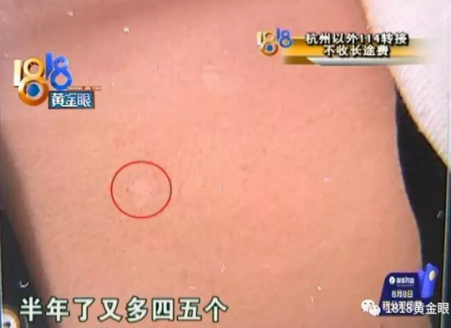 患者在杭州麗都白癜風醫院花冤枉錢？原本只需200元卻花了近六千