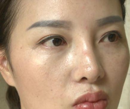 杭州美萊美容醫(yī)院把我鼻子做壞了 高價隆鼻后凹凸不平