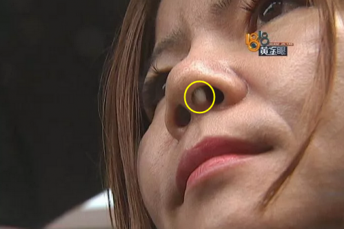 六年前在寧波珈禾整形專科醫(yī)院做隆鼻 現(xiàn)在鼻子不舒服露出白色假體