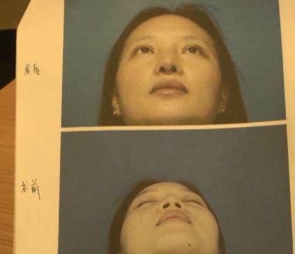 杭州美萊美容醫(yī)院把我鼻子做壞了 高價隆鼻后凹凸不平