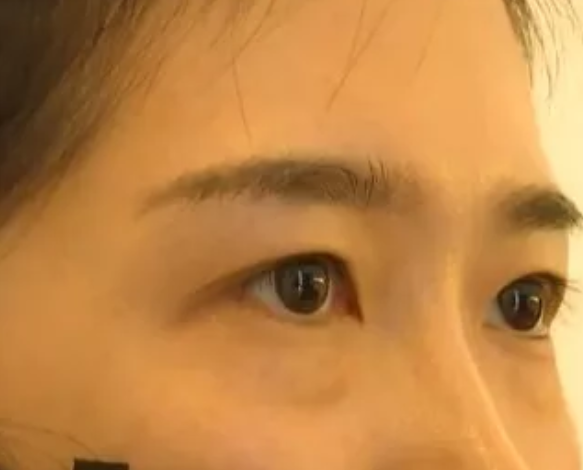 女子在杭州珈禾整形美容醫院打熊貓針結果變成熊貓眼?-易網健康養生網 女子在杭州珈禾整形美容醫院打熊貓針結果變成熊貓眼?