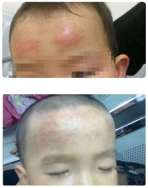 網(wǎng)紅退熱貼真這么神奇嗎?只能物理降溫 有的孩子出現(xiàn)過敏表現(xiàn)-易網(wǎng)<a href=http://m.henggaotouzi.com/ target=_blank class=infotextkey>健康養(yǎng)生</a>網(wǎng) 網(wǎng)紅退熱貼真這么神奇嗎?只能物理降溫 有的孩子出現(xiàn)過敏表現(xiàn)