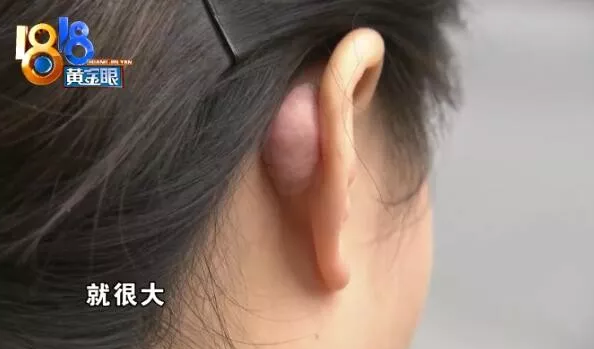 杭州千晴整形醫(yī)院隆鼻后耳后根長了個包 鼻孔也一大一小-易網(wǎng)健康<a href=http://m.henggaotouzi.com/jkys/ target=_blank class=infotextkey>養(yǎng)生</a>網(wǎng) 杭州千晴整形醫(yī)院隆鼻后耳后根長了個包 鼻孔也一大一小