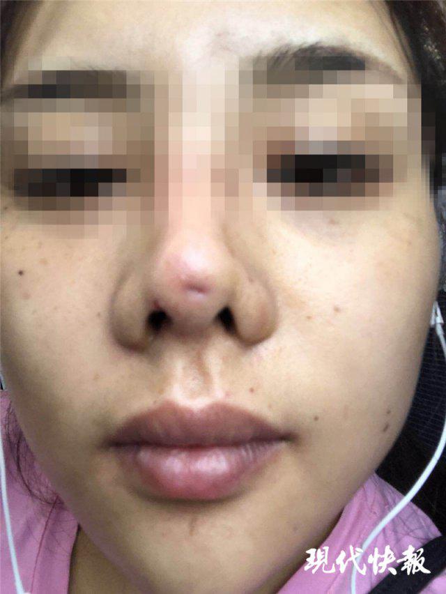 南京怡華醫(yī)療美容醫(yī)院整形失敗 90后姑娘隆鼻后成了“豬鼻子”