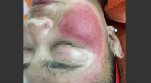 成都：莊美斑敏痘激素臉修復(fù)中心祛斑 剛回去臉上出現(xiàn)密密麻麻紅疹