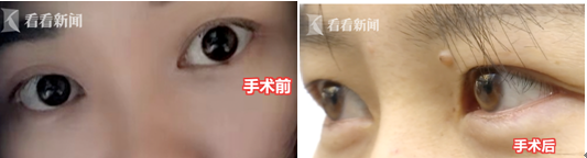 貴陽聚星妍美整形機構又出問題了 雙眼皮整成了單眼皮？