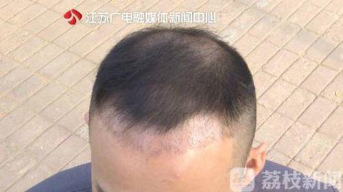 南京美貝爾整形醫院聲稱植發成活率95% 可植發一個月掉了一半-易網健康<a href=http://m.henggaotouzi.com/jkys/ target=_blank class=infotextkey>養生</a>網 南京美貝爾整形醫院聲稱植發成活率95% 可植發一個月掉了一半