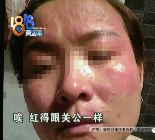 本想“逆時光” 結果密思芬美容后臉紅得像關公不敢見人-易網<a href=http://m.henggaotouzi.com/ target=_blank class=infotextkey>健康養(yǎng)生</a>網 本想“逆時光” 結果密思芬美容后臉紅得像關公不敢見人