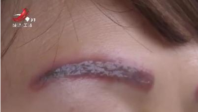 去南昌韓美美容醫院激光洗眉后生不如死 洗完感覺自己像怪物-易網健康<a href=http://m.henggaotouzi.com/jkys/ target=_blank class=infotextkey>養生</a>網 去南昌韓美美容醫院激光洗眉后生不如死 洗完感覺自己像怪物