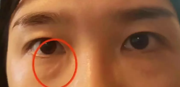 女子在杭州珈禾整形美容醫院打熊貓針結果變成熊貓眼?-易網健康養生網 女子在杭州珈禾整形美容醫院打熊貓針結果變成熊貓眼?