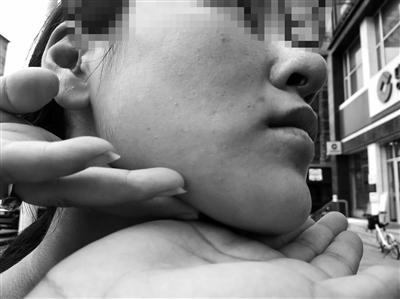 沈陽茗湲醫療美容整容失敗 25歲女孩鼻子填充物外露不敢出門見人