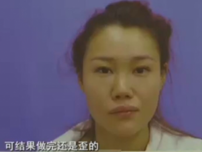 杭州格萊美整形醫院把美女鼻子成了S型 只敢開美顏拍照