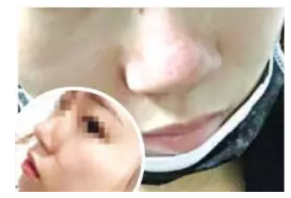 泉州逸膚中醫(yī)皮膚病醫(yī)院激光祛痘坑失敗 院方：已辦理退款