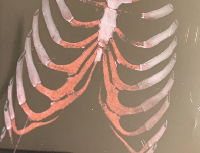 南京普羅普姿醫(yī)療美容門(mén)診做假手術(shù)？神操作！劃個(gè)口子就當(dāng)取了肋骨