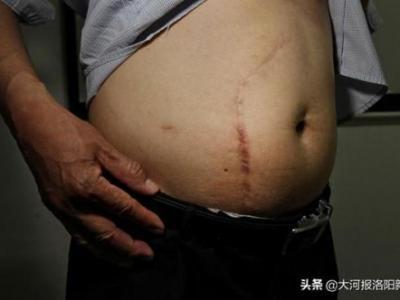 13年前只在洛陽市商業(yè)職工醫(yī)院做過一次闌尾手術(shù) 為何膽囊不見了？