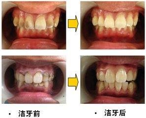 杭州美奧口腔怎么樣？洗牙能去除煙漬嗎