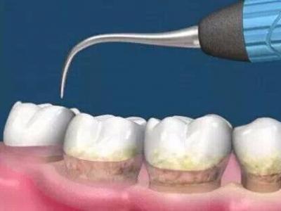 杭州美奧口腔怎么樣？洗牙能去除煙漬嗎