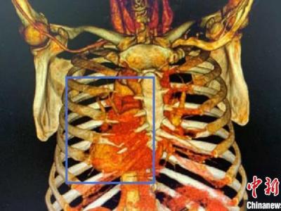 上海市權(quán)威專(zhuān)家獨(dú)辟新徑取得成功救護(hù)與生俱來(lái)“異”心人