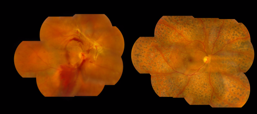 希瑪眼科：適時進行針對性治療，糖網患者視力大多可保留