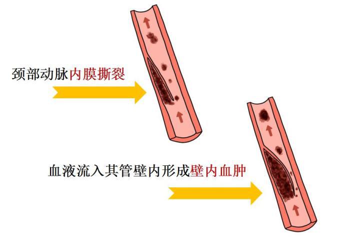 【醫線觀察】按摩拉伸、拔火罐、“種草莓”會得腦中風？