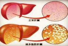 從脂肪肝到肝癌只需4步！做錯這6件事，最容易得脂肪肝！