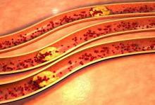 血管洗個澡，健康活到老！