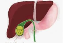 如何護(hù)理膽結(jié)石？高危人群要注意